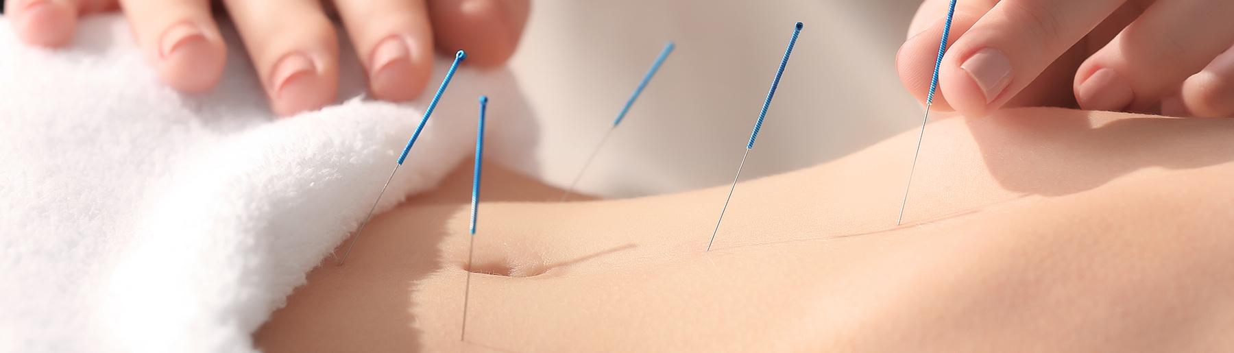 hands placing acupuncture needles